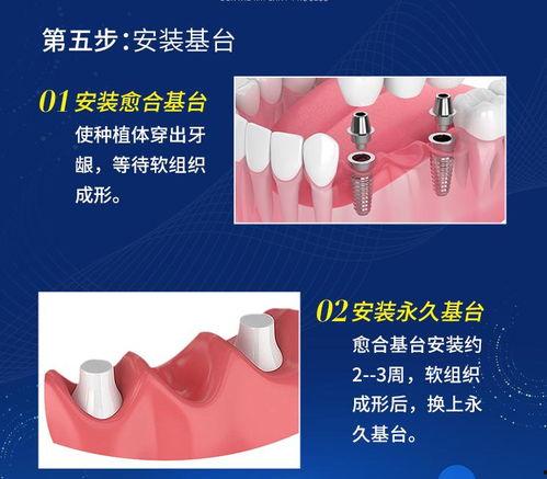 今日头条种植牙齿文案,种植牙齿的全新体验与优势